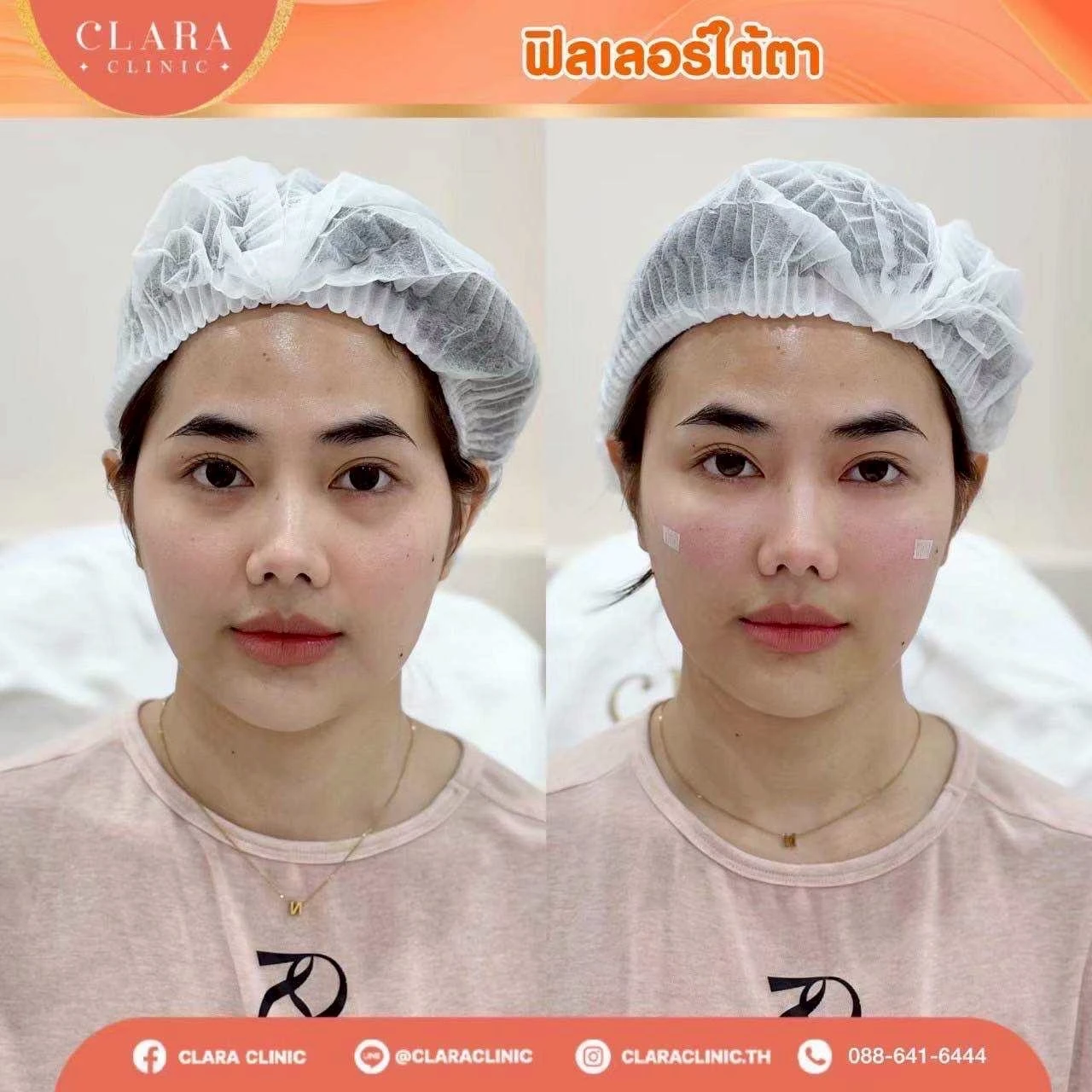 CLARA Review