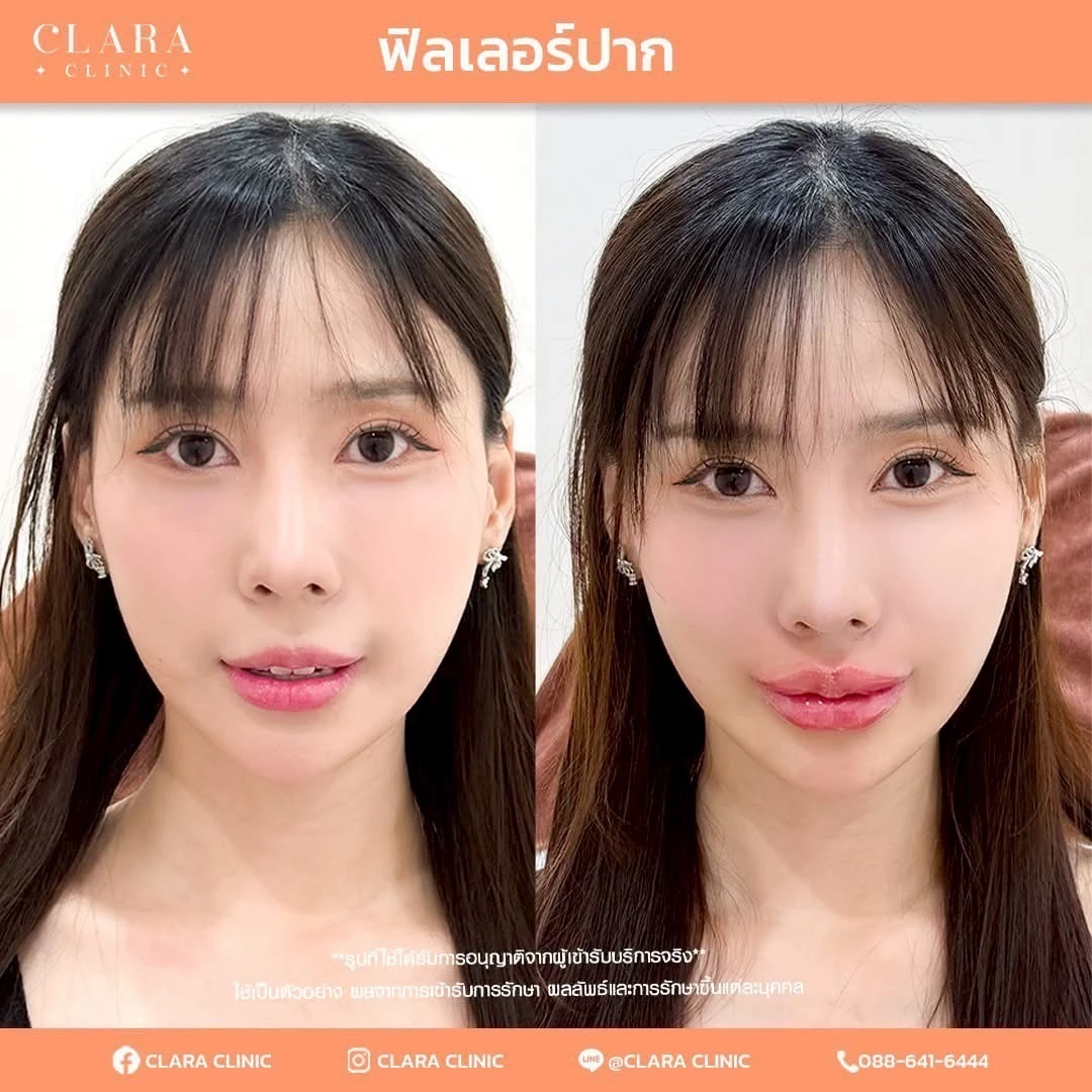 CLARA Review