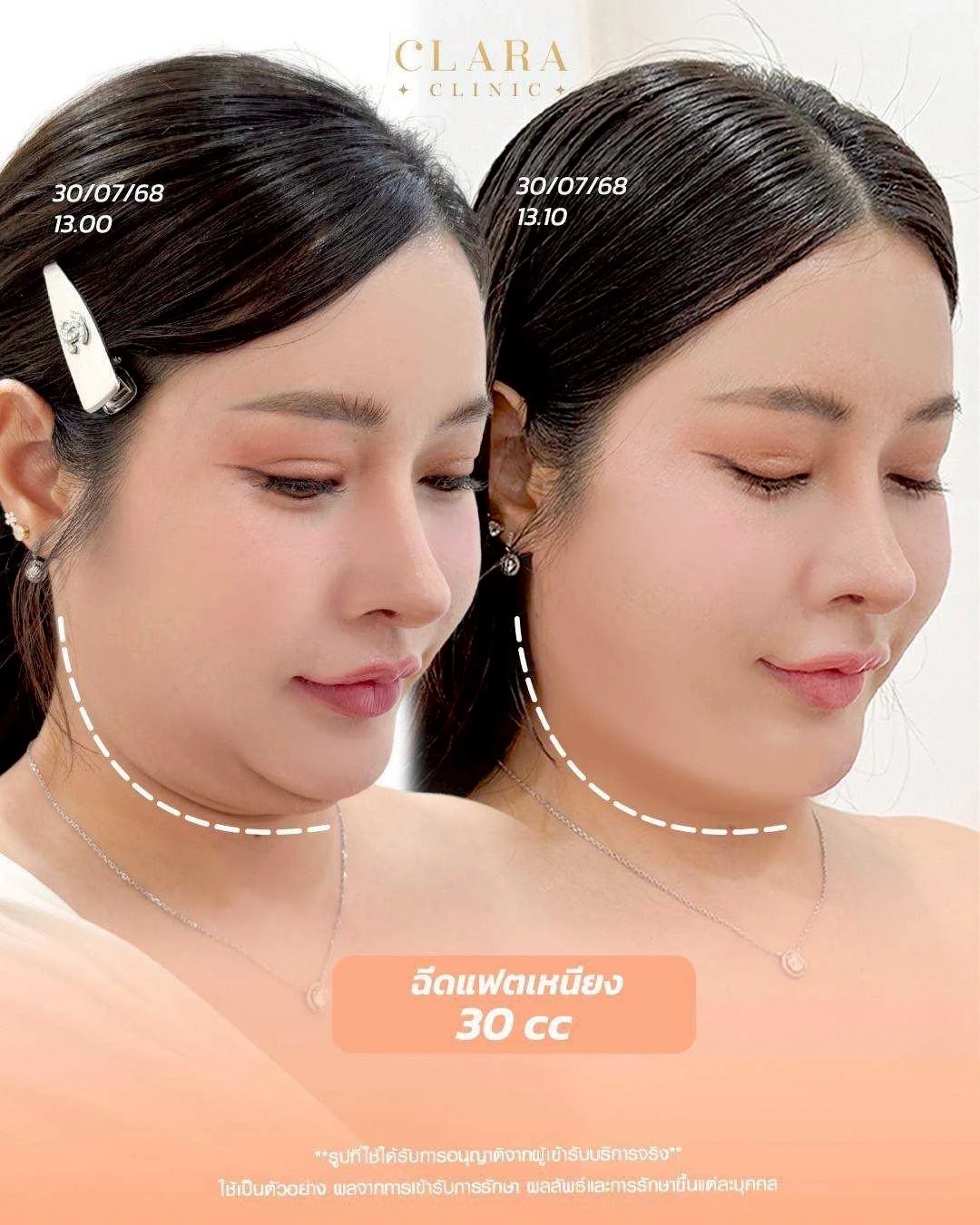 CLARA Review