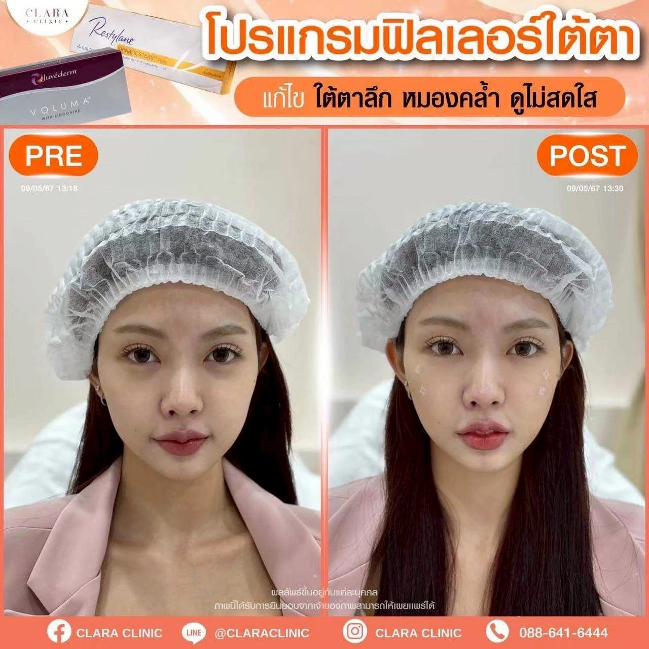 CLARA Review