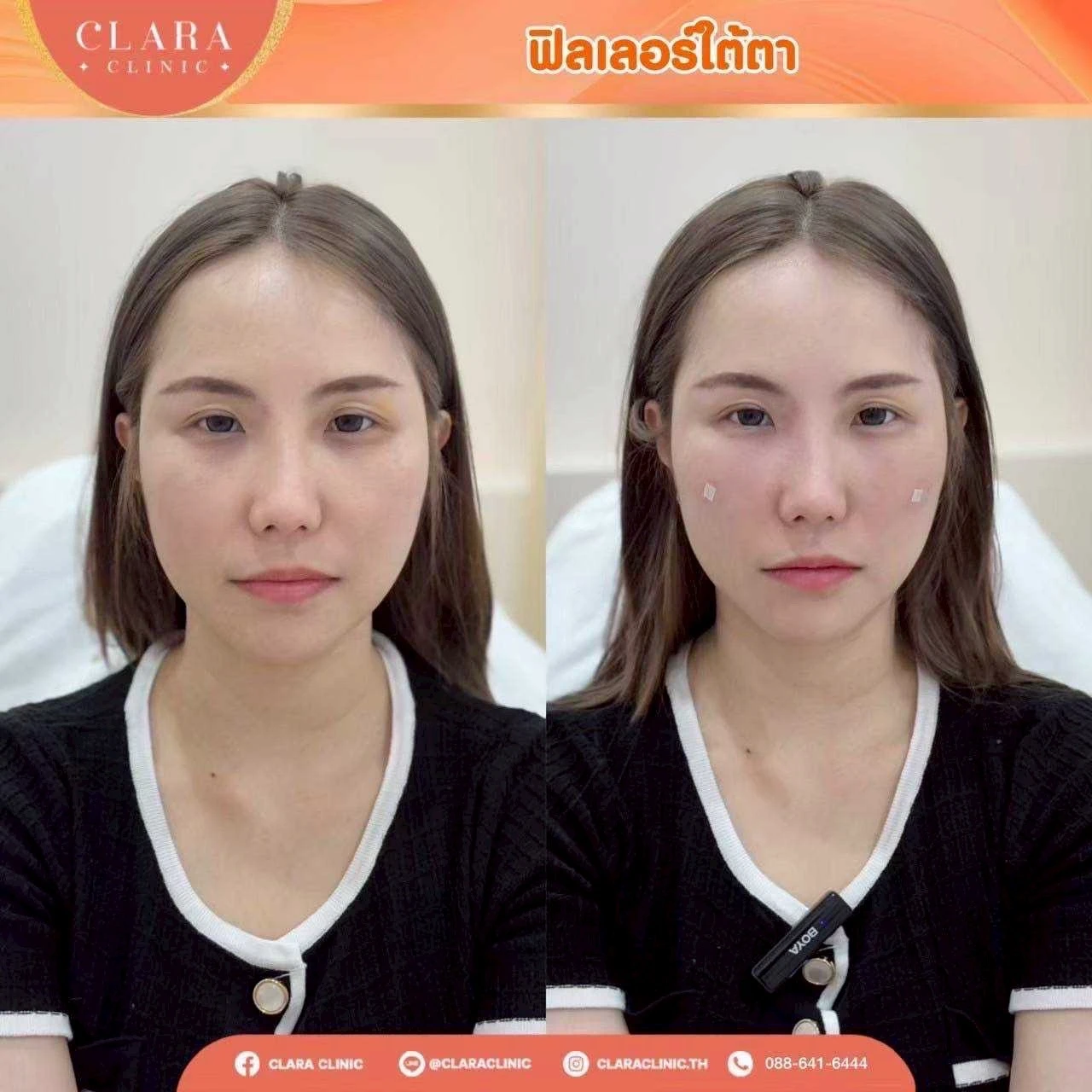 CLARA Review
