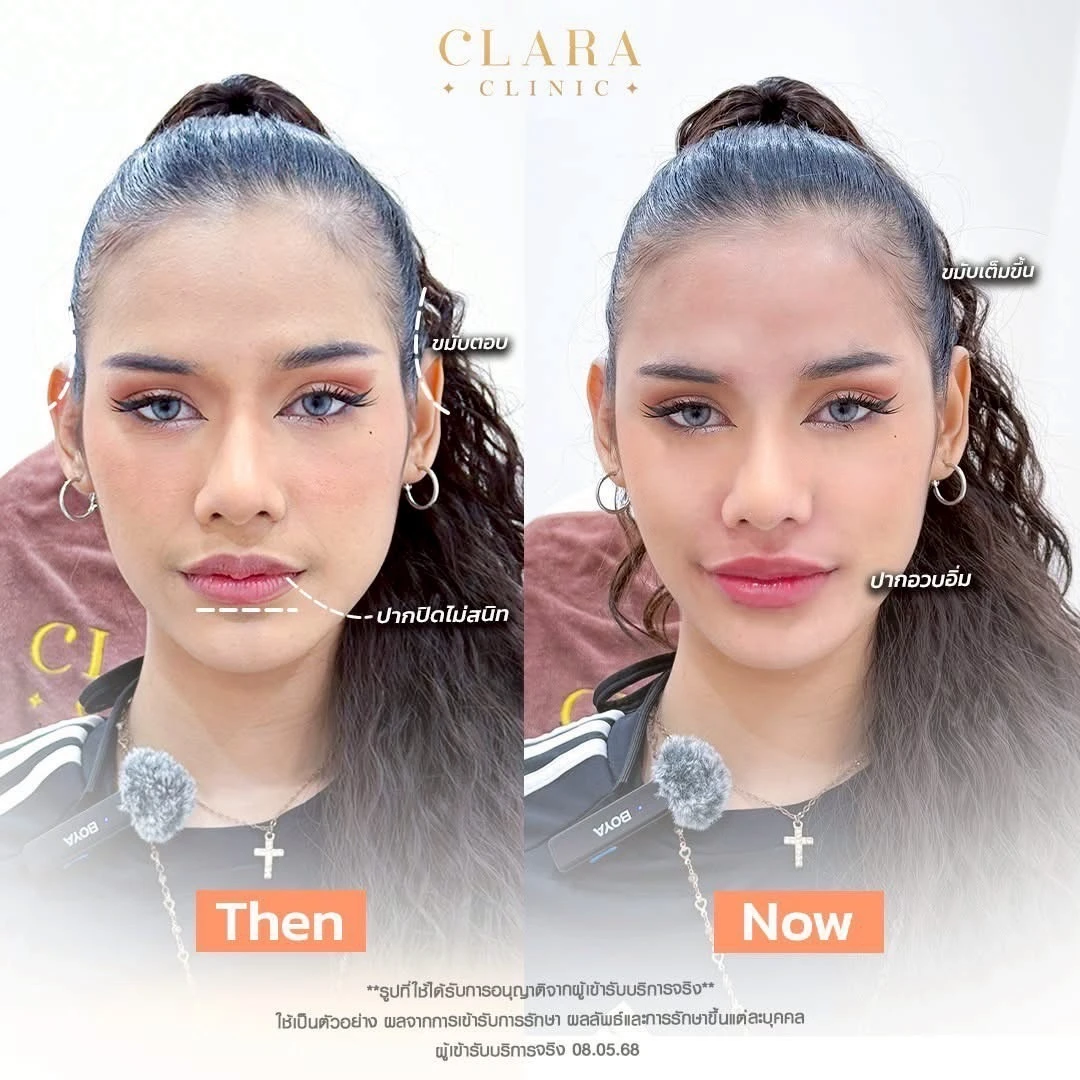 CLARA Review